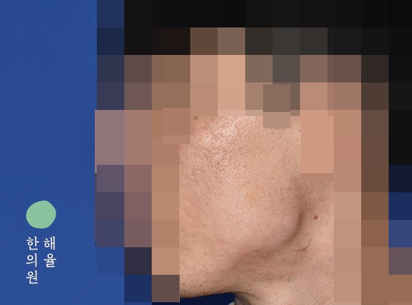 [울산점] 얼굴화농성여드름 치료 후 사진 - 해율한의원
